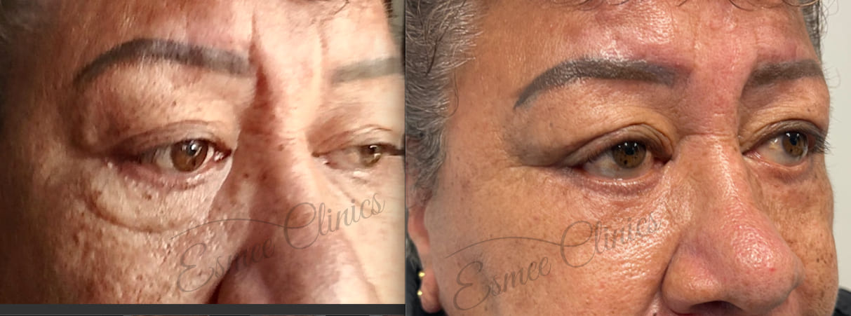 Before and After img